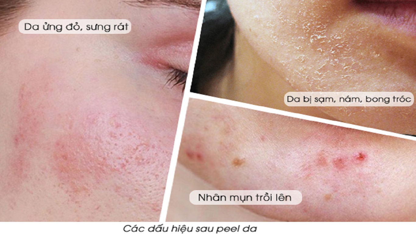 Bao lâu peel da 1 lần 3